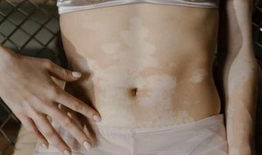 Ayurvedic Insights into Vitiligo: Holistic Treatment with Diet and Lifestyle Recommendations