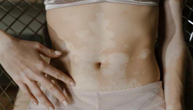 Ayurvedic Insights into Vitiligo: Holistic Treatment with Diet and Lifestyle Recommendations